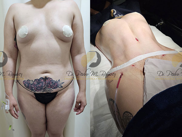 Lipoescultura en Guadalajara